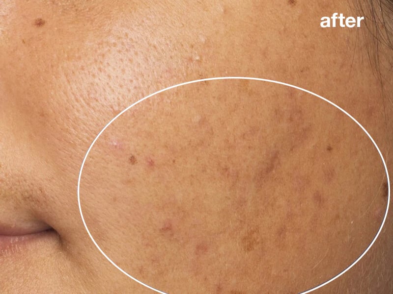 pro power peel
