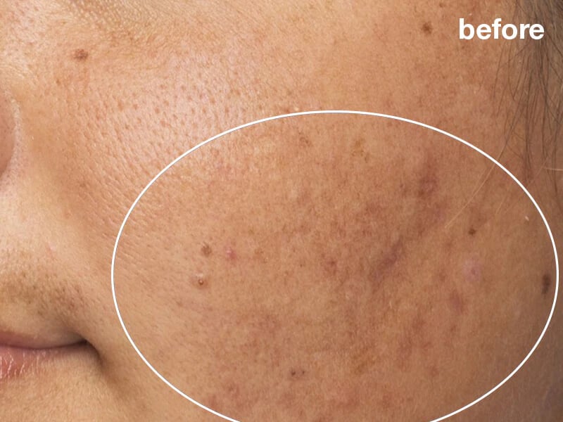 pro power peel