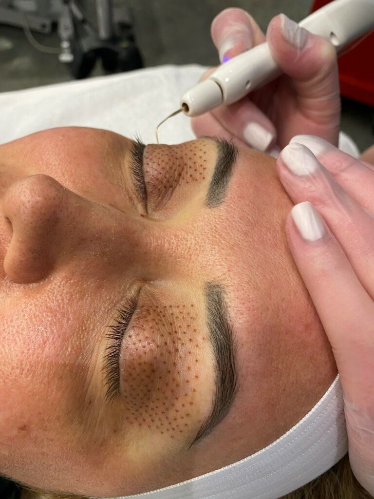 fibroblast plazma pen ile pro restore