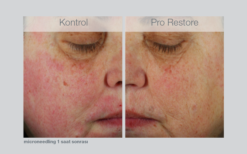 Post-microneedling treatment: decrease of redness